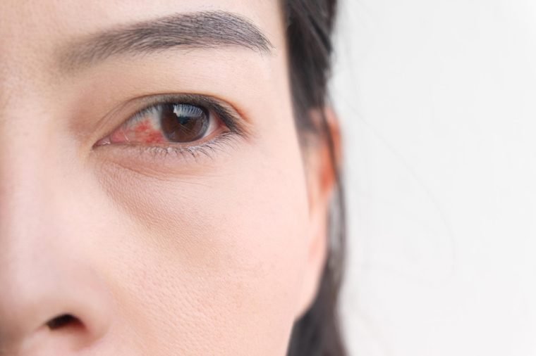 Conjunctivitis: Is Your Eye Going Pink Again?