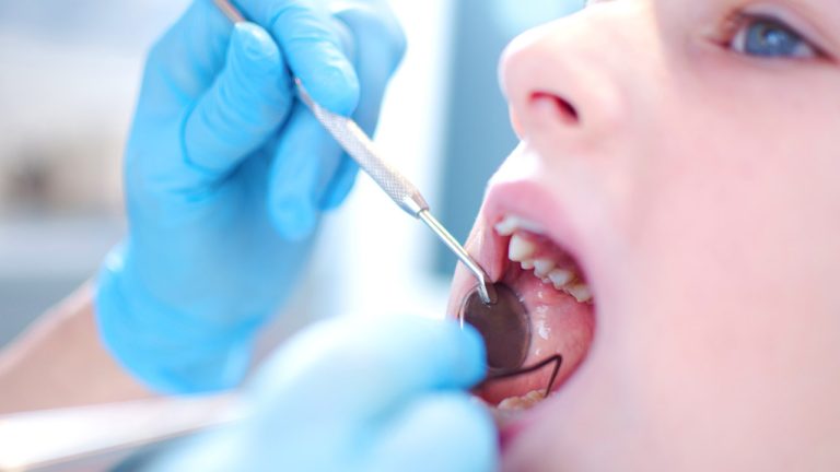 What Are Cavities And How To Prevent Them?