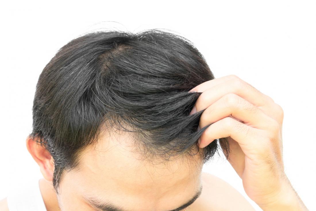 Hair transplant process to regrow your hair in a natural way