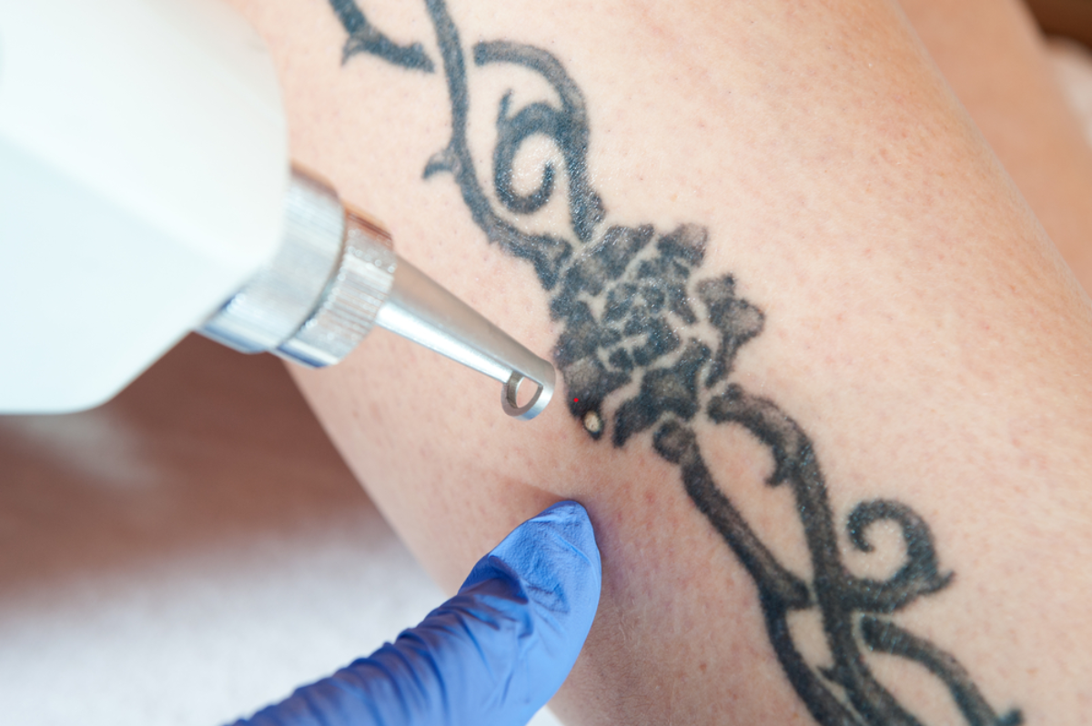 The Best Tattoo Removal Resources Near You
