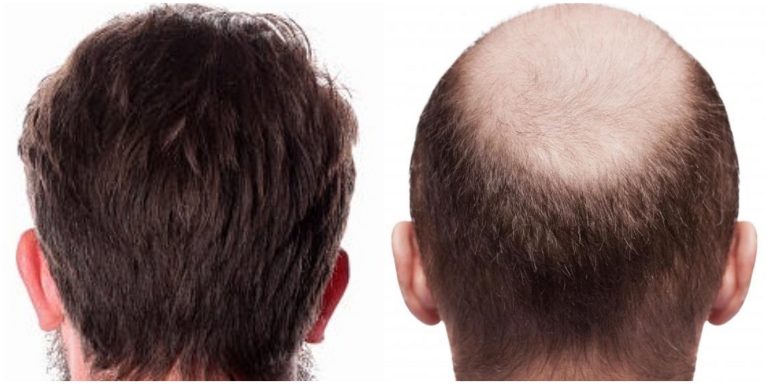 5 Reasons Turkey Is A Good Place to Go for A Hair Transplant